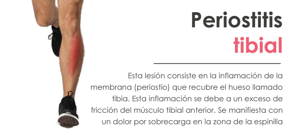 Tratamiento de la periostitis tibial en Sevilla