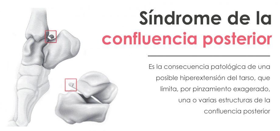 Síndrome de la confluencia posterior