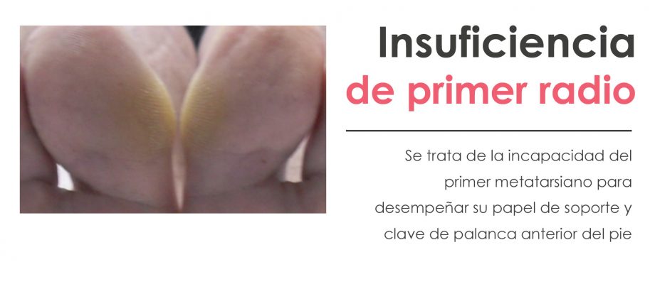 insuficiencia de primer radio