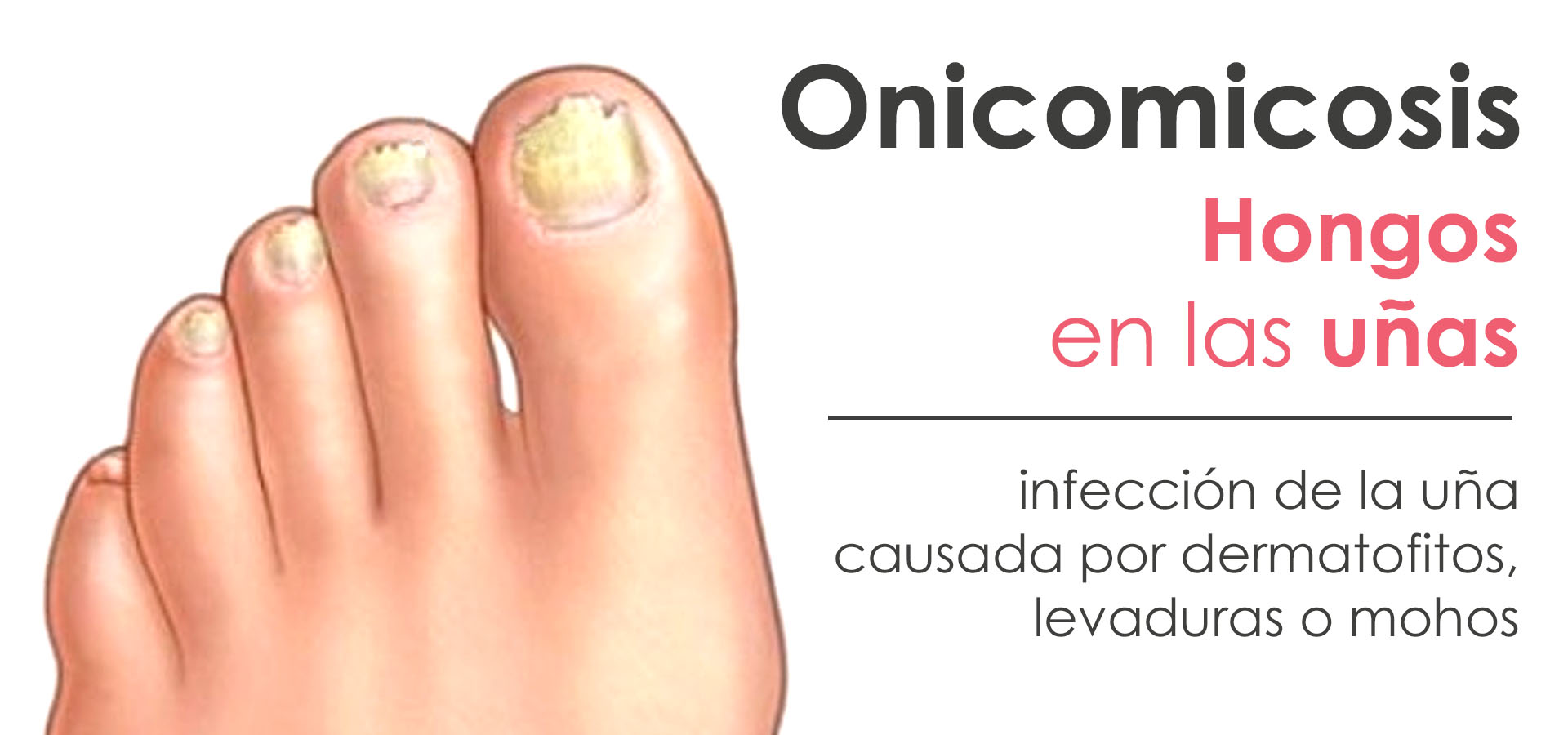 Onicomicosis (hongos en las uñas)