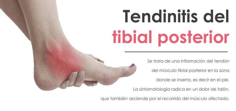 Tendinitis del tibial posterior