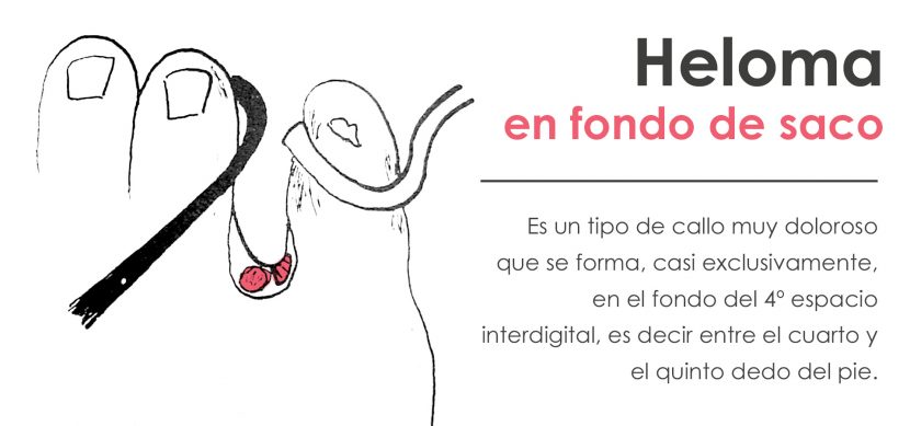 Heloma en fondo de saco