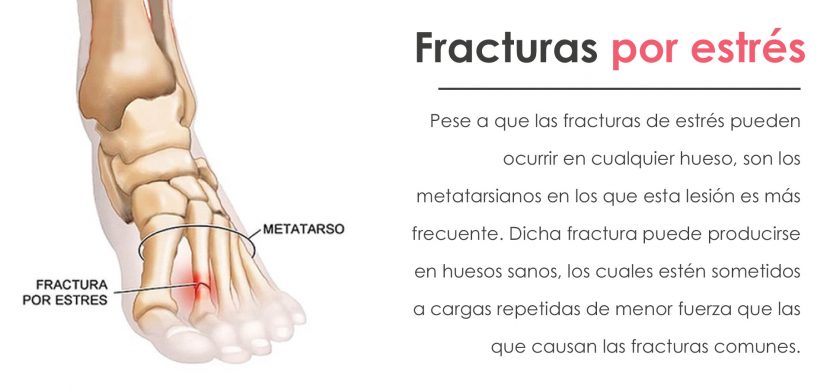 fracturas por estres
