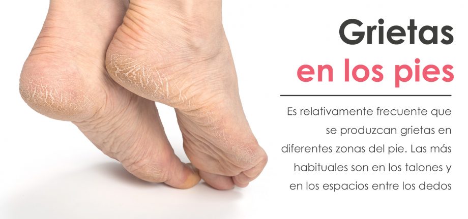 grietas en los pies