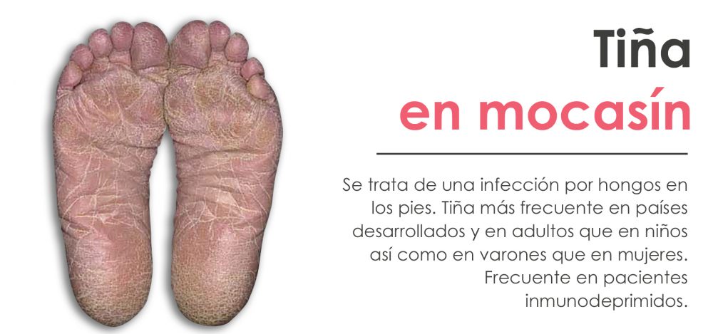 Tiña en mocasín